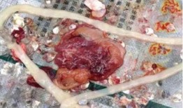 肚子里的虫子视频,揭秘人体寄生虫的奥秘与防治