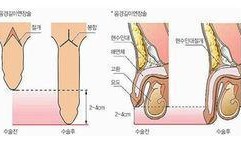 北京阴茎延长术视频,技术革新与术后恢复全解析