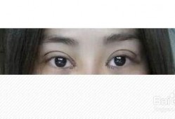 切开双眼皮视频